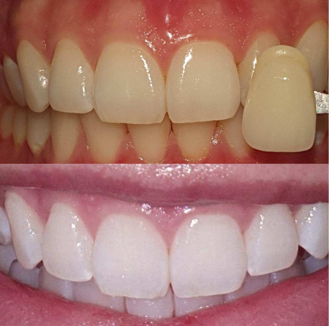 Clareamento Dental - Clínica DYVARE